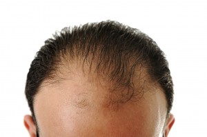 Man loosing hair, baldness